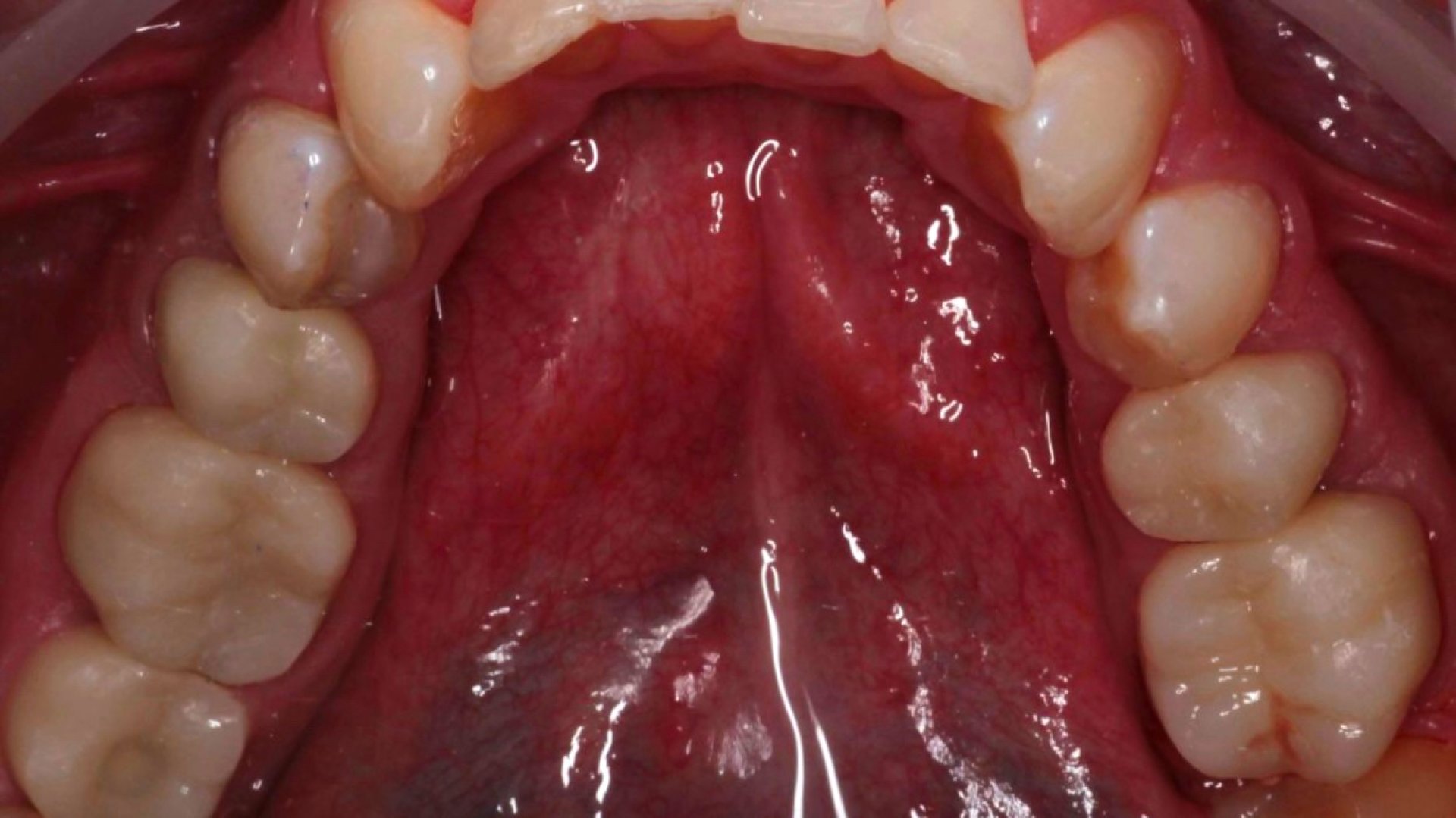 Циркониевые коронки на жевательные зубы. 3.5-3.6, 4.5-4.6_after