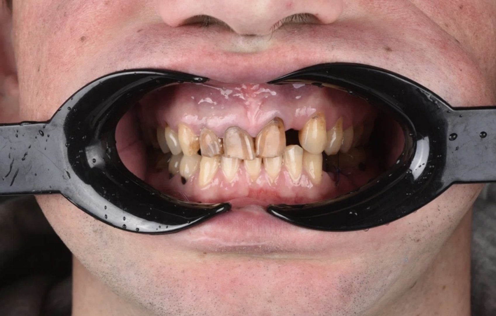 Протезирование и устранение рецессий_before