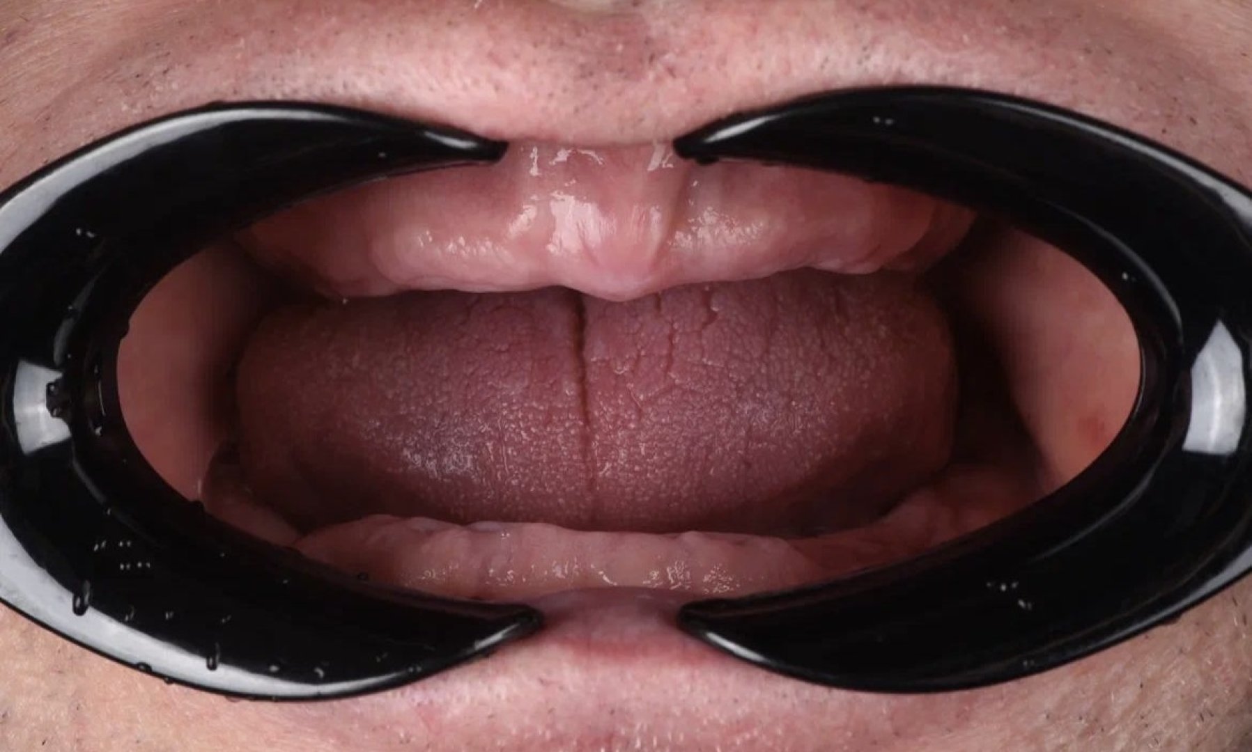 Состояние до протезирования акриловым протезом