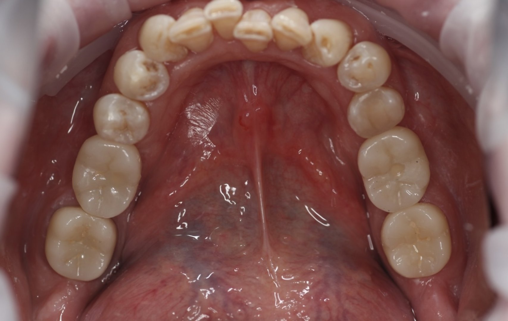 Коронки на имплантатах_after