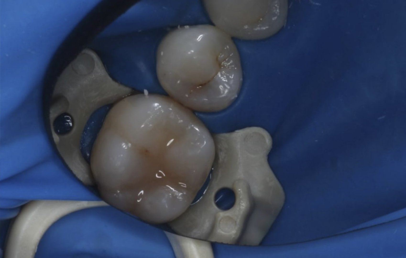 Леч. кариеса 2х зубов и художественная реставрация (кейс 2)_before