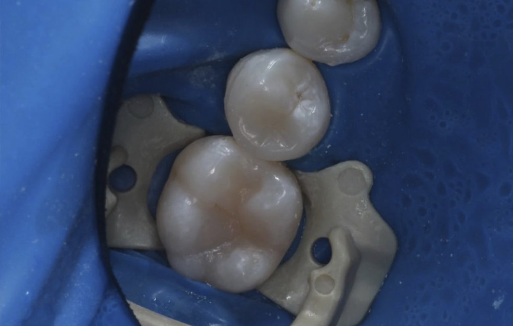 Леч. кариеса 2х зубов и художественная реставрация (кейс 2)_after