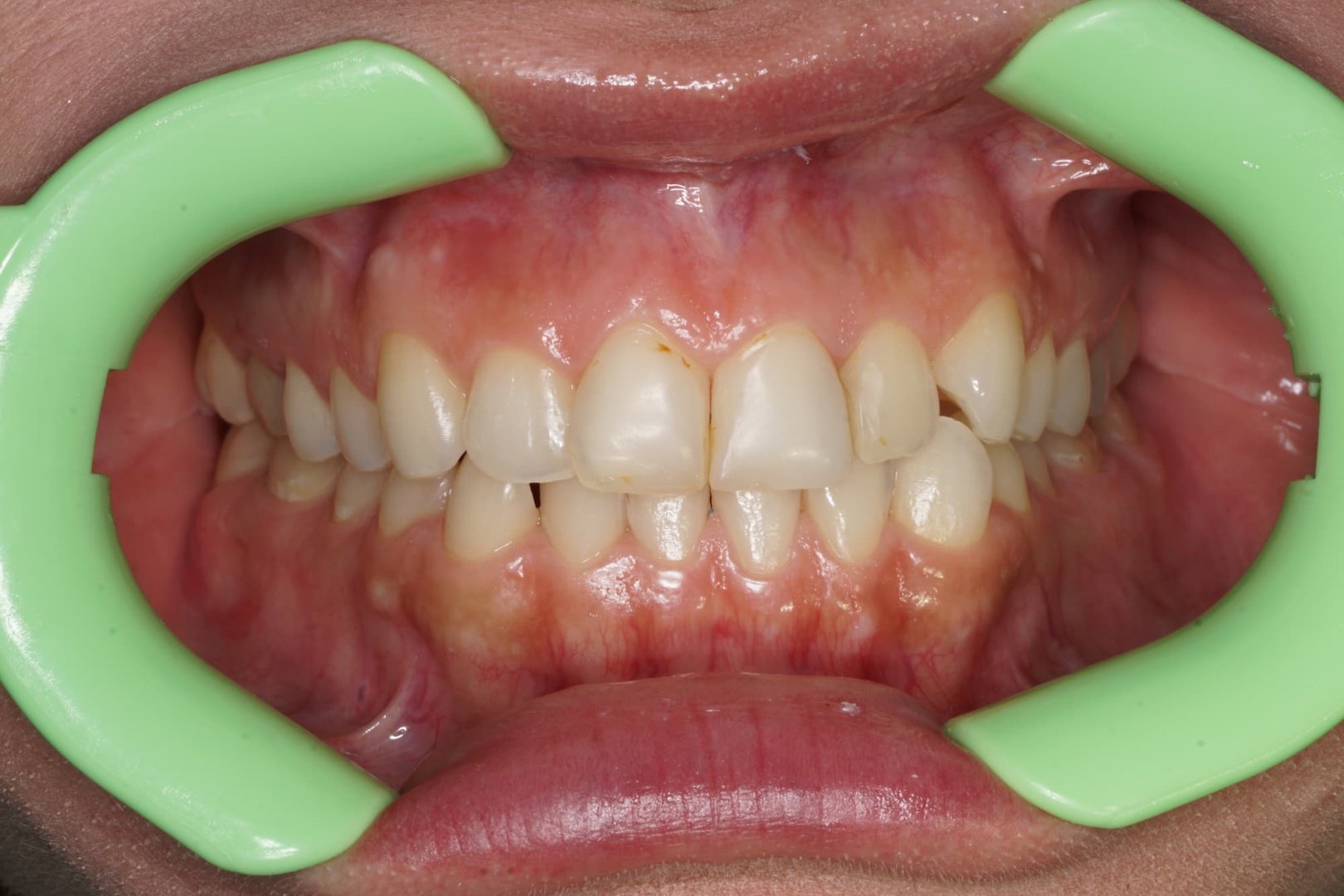 Лечение на элайнерах. Кейс 1