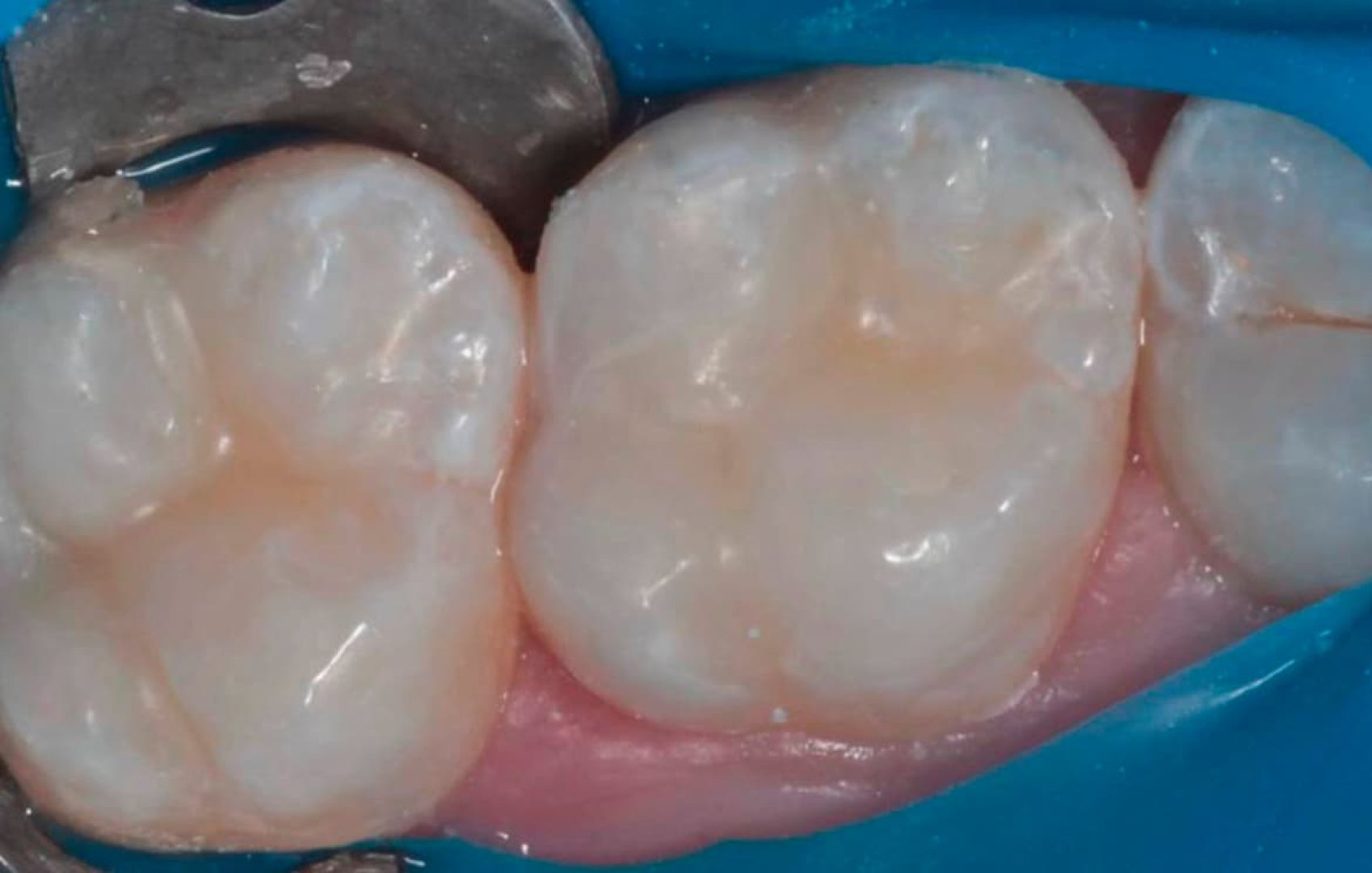 Кариес на жевательной поверхности (Зубы 2.6, 2.7)_after