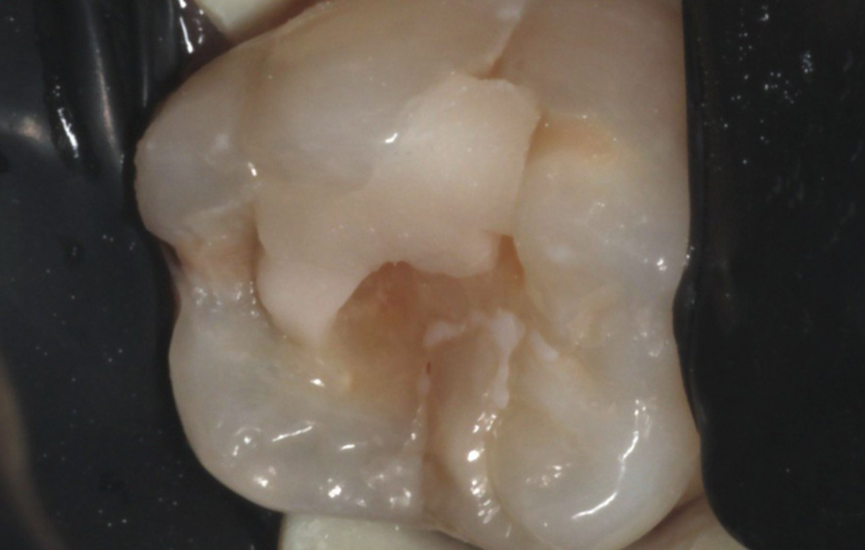 Лечение кариеса_before