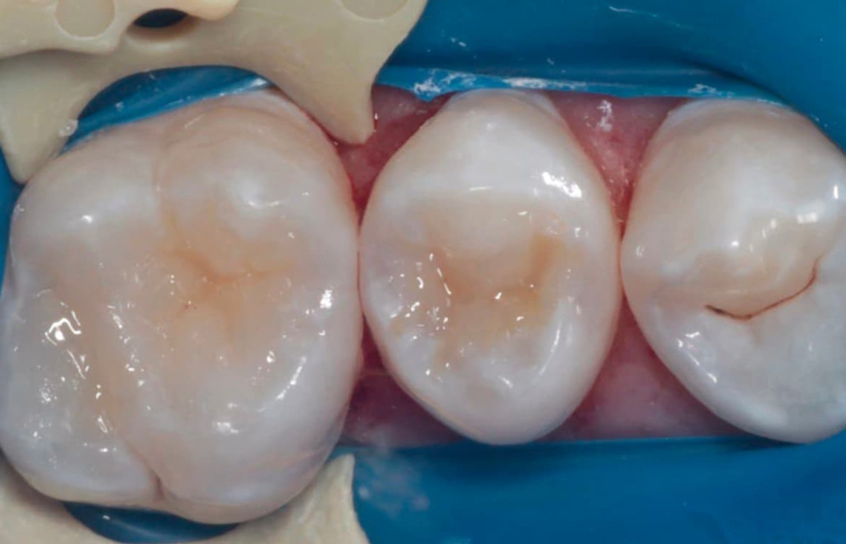 Лечение кариеса_after