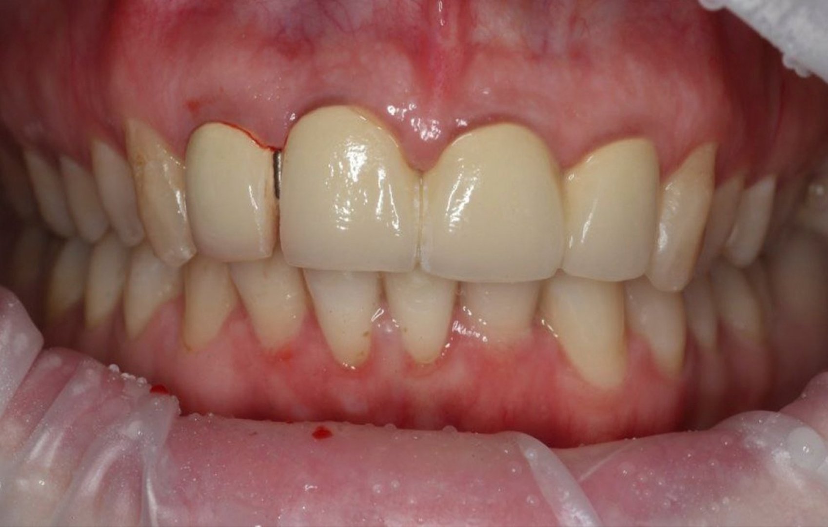 Перепротезирование фронтальной группы зубов_before