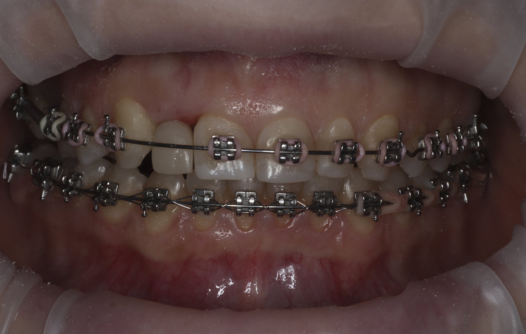 Комплексное ортопедическое и хирургическое лечение_before