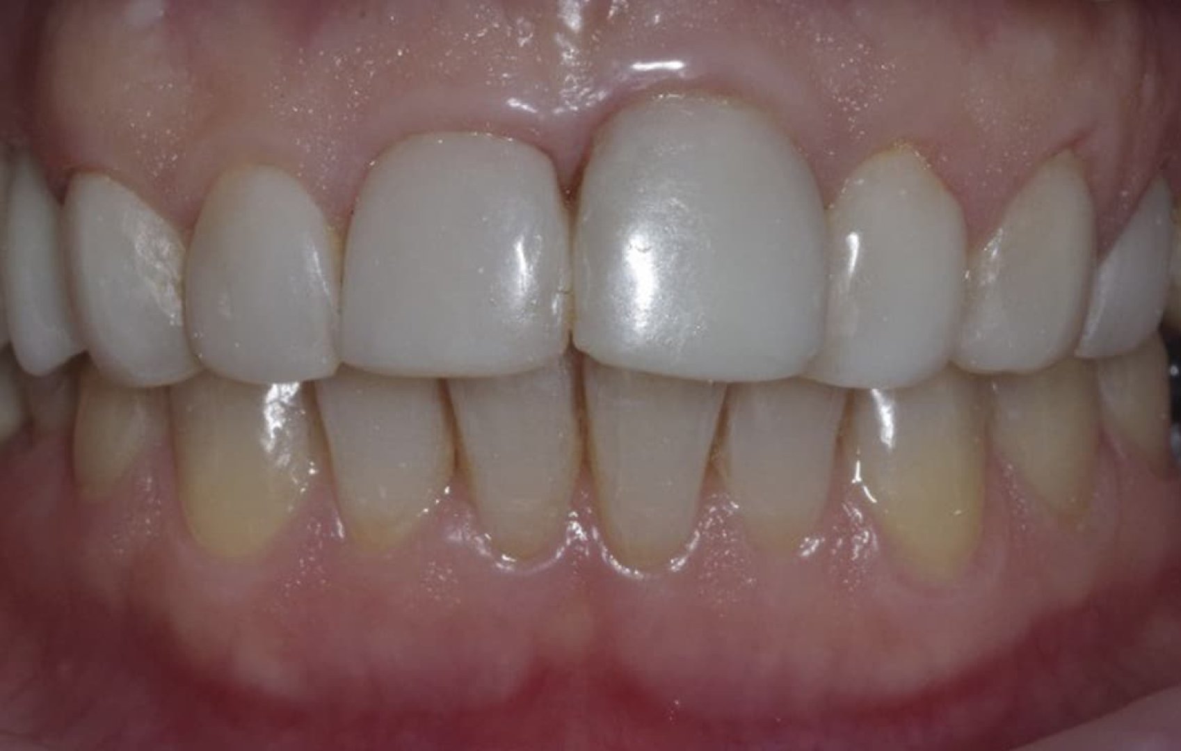 Восстановление и протезирование зубов диоксид-циркониевыми коронками_before