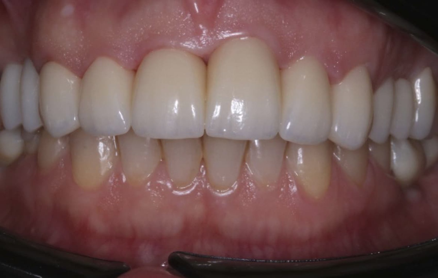 Восстановление и протезирование зубов диоксид-циркониевыми коронками_after