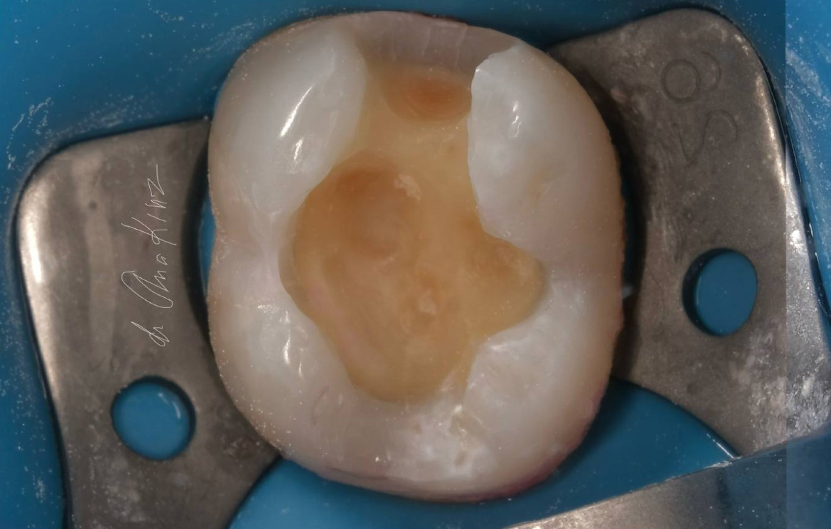 Комплексное лечение жевательного отдела_before