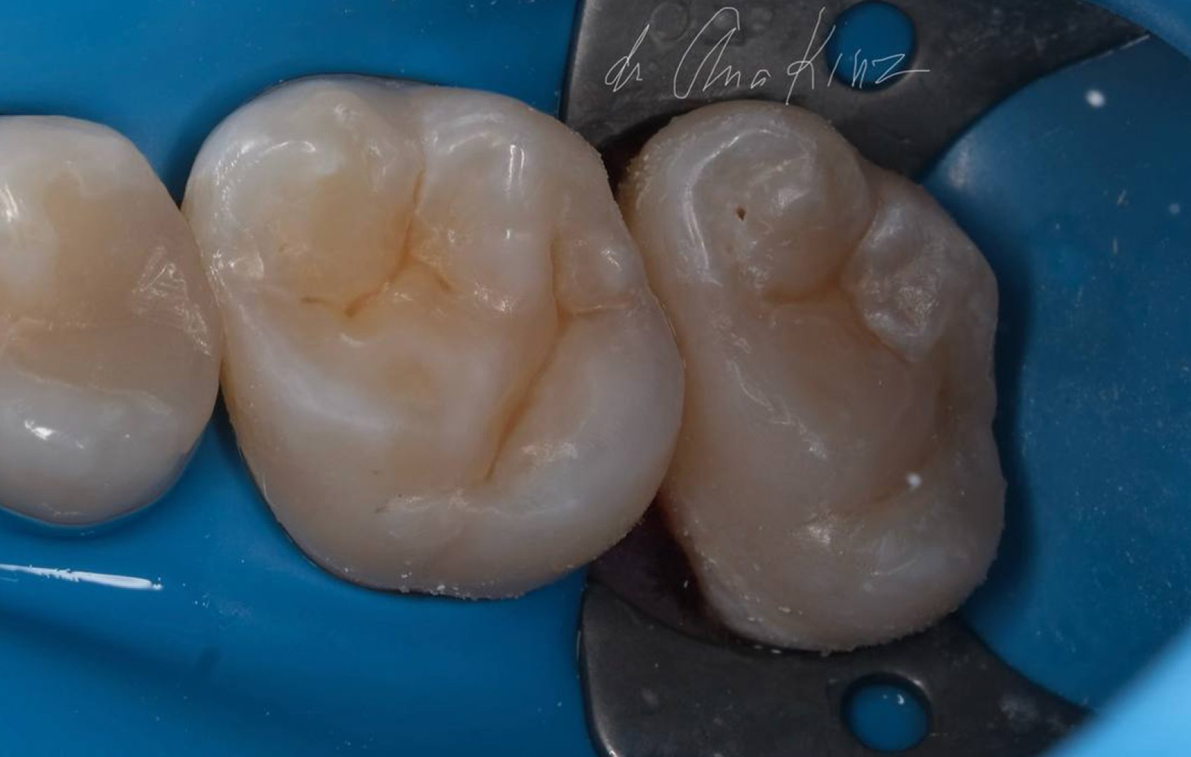 Комплексное восстановление жевательных зубов_after