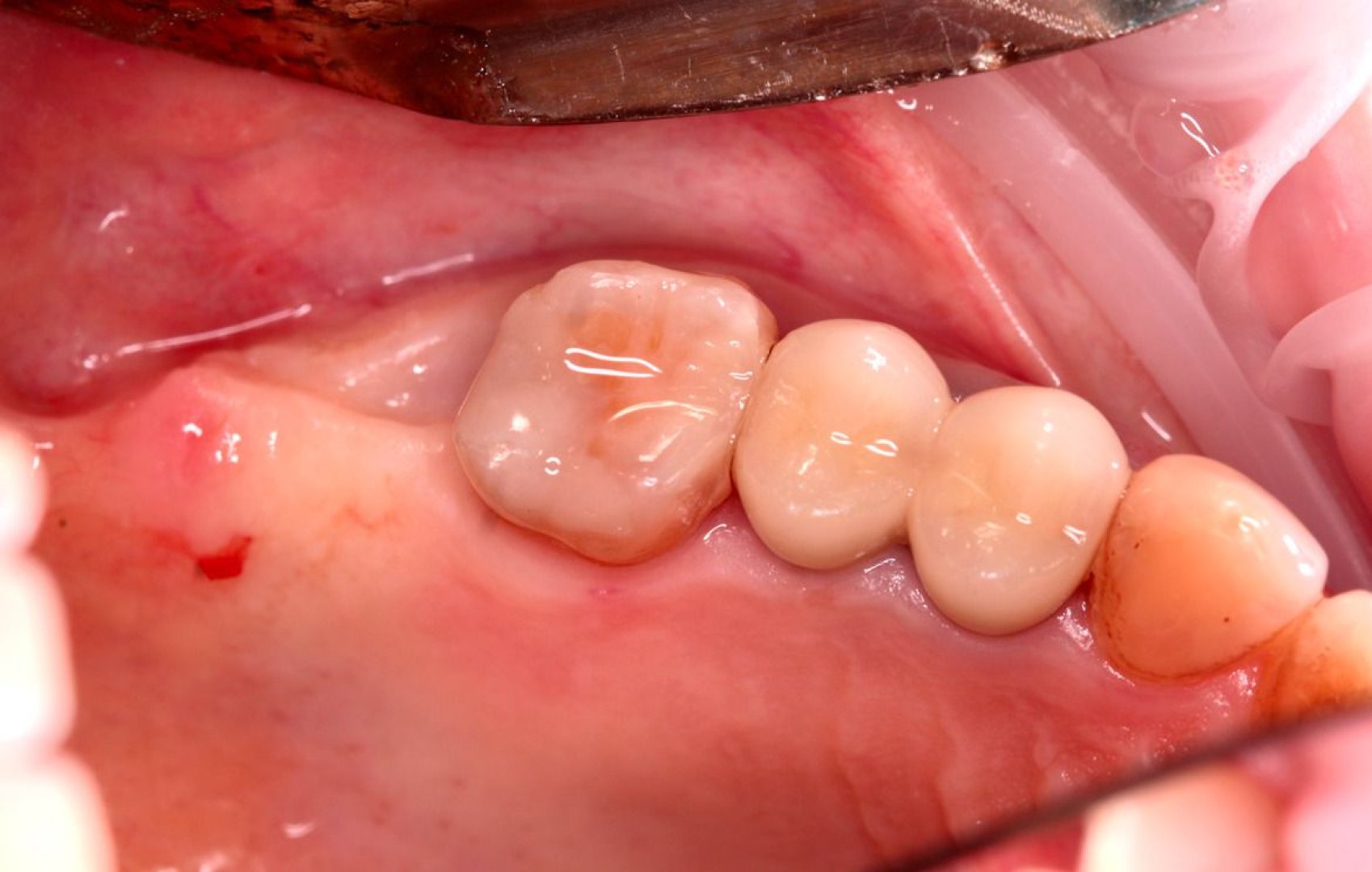 ustanovka-implantata-s-plastikoy-desny-1