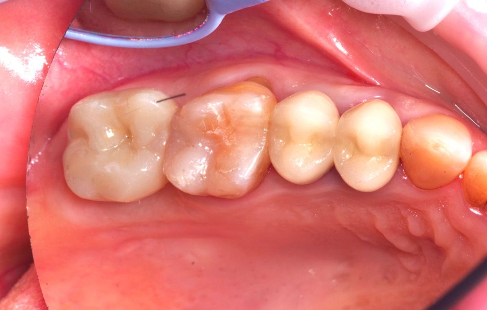 ustanovka-implantata-s-plastikoy-desny-2