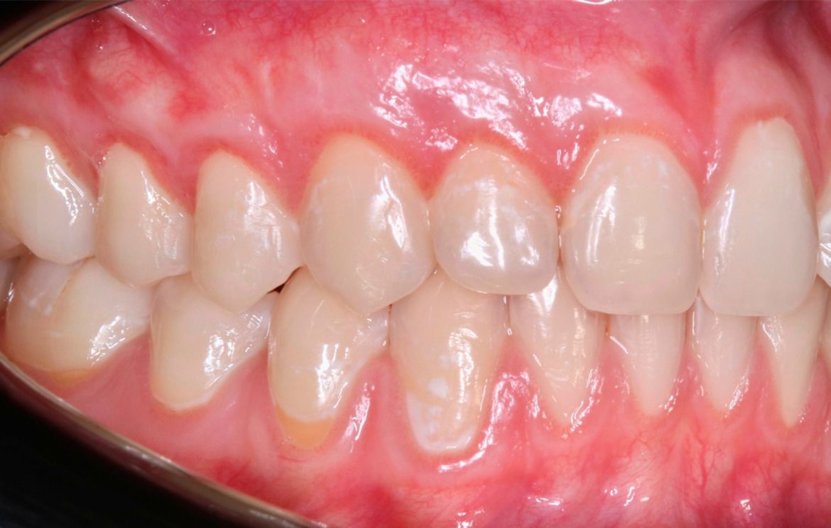 Закрытие оголённых корней зубов