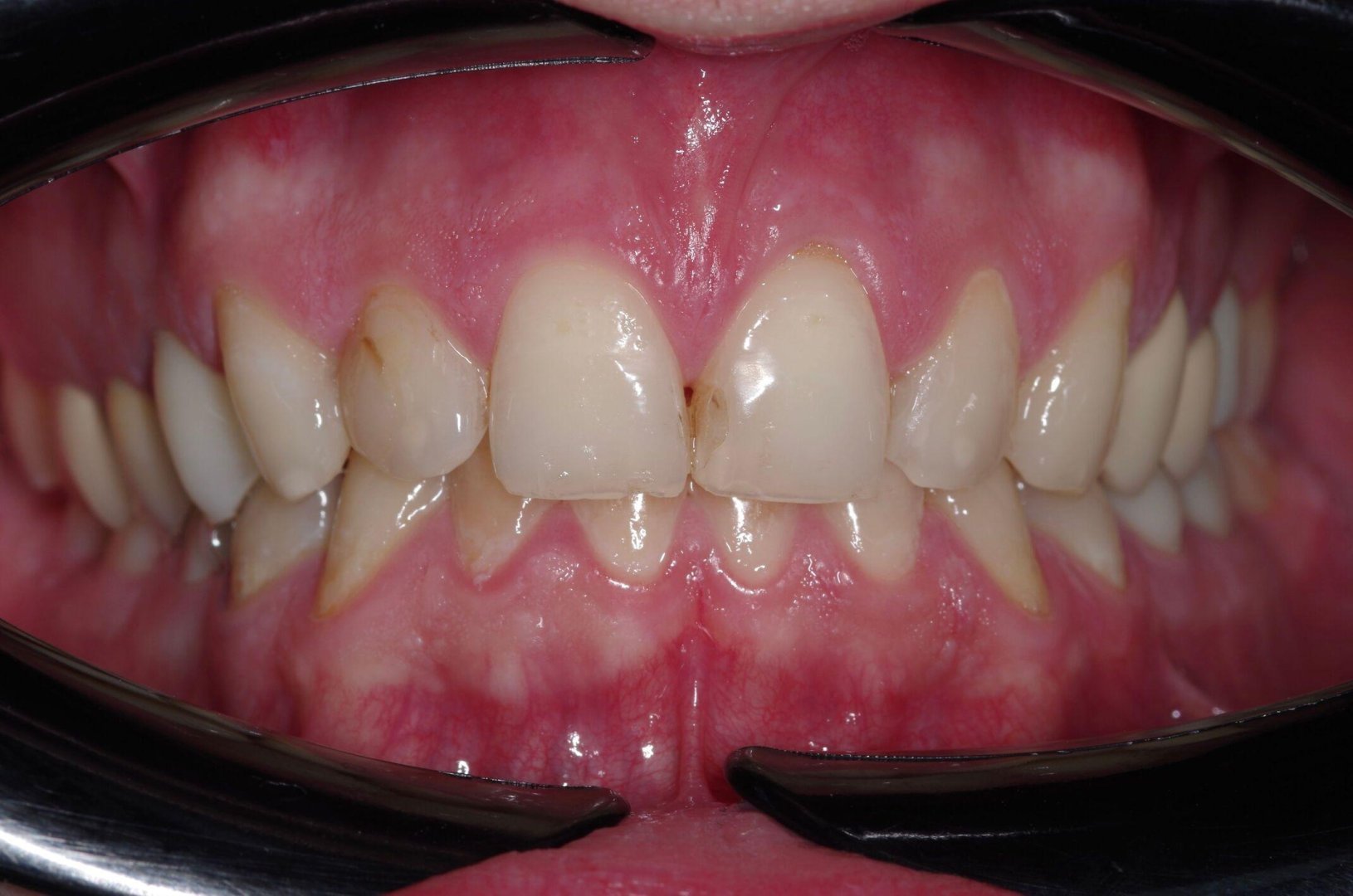 Состояние зубов до установки виниров