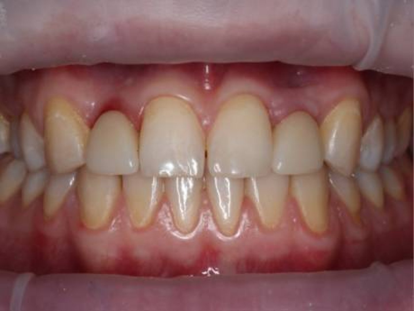 vremennye-koronki-na-implantaty-formirovanie-desny