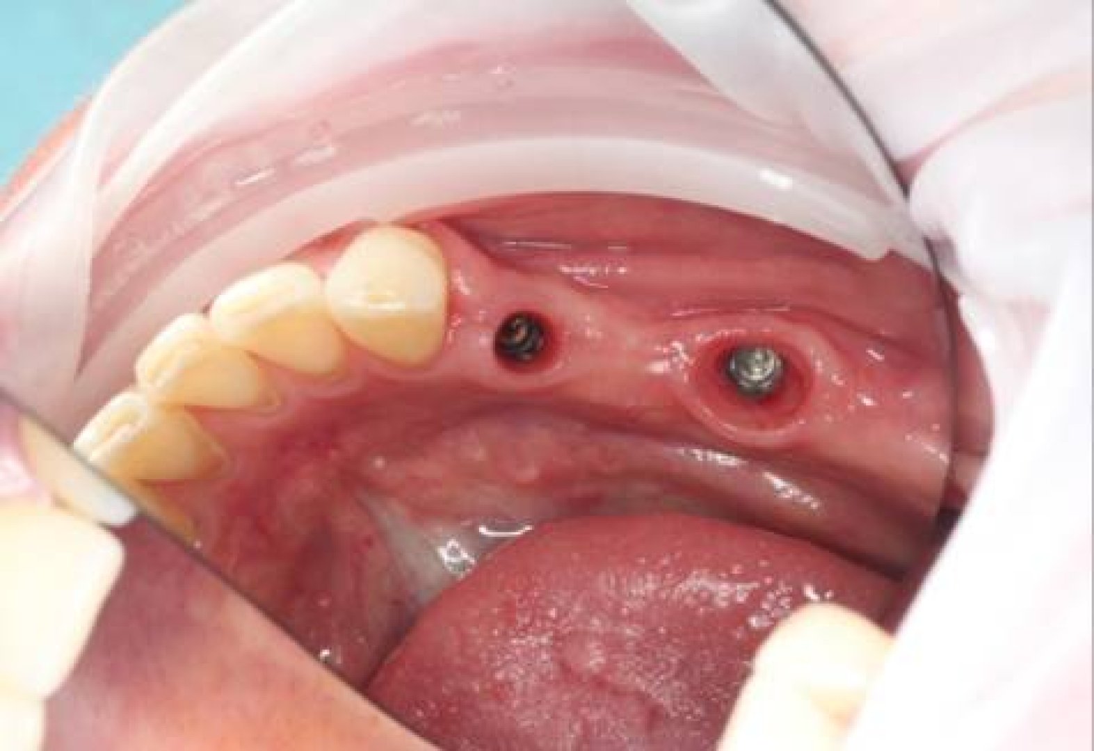 vremennye-koronki-na-dva-implantata-do