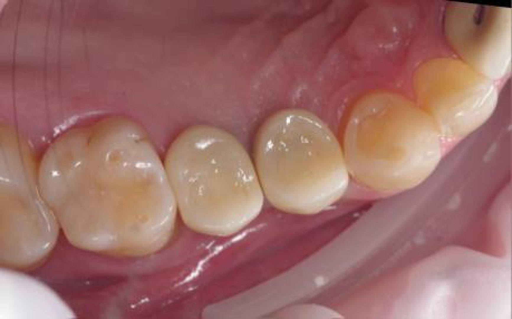postoyannye-koronki-na-dva-implantata-posle