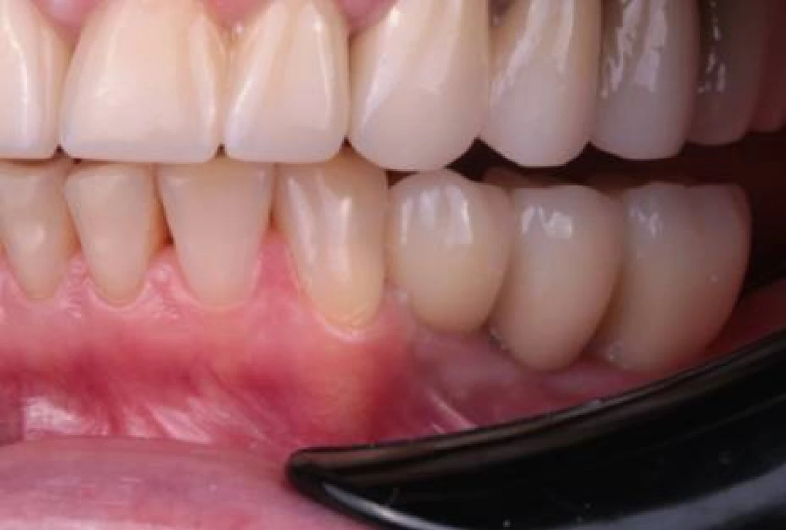 postoyannye-koronki-na-dva-implantata-sleva-posle