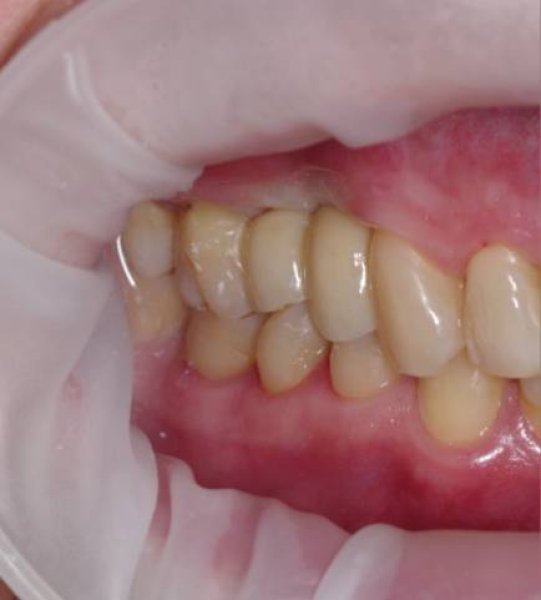 postoyannye-koronki-na-dva-implantata-and
