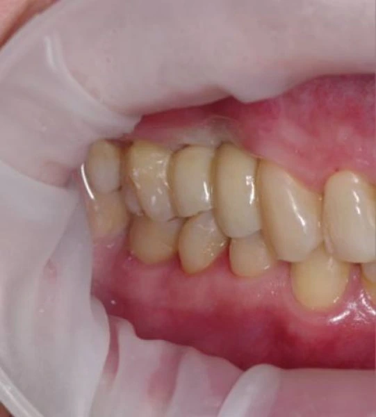 postoyannye-koronki-na-dva-implantata-and