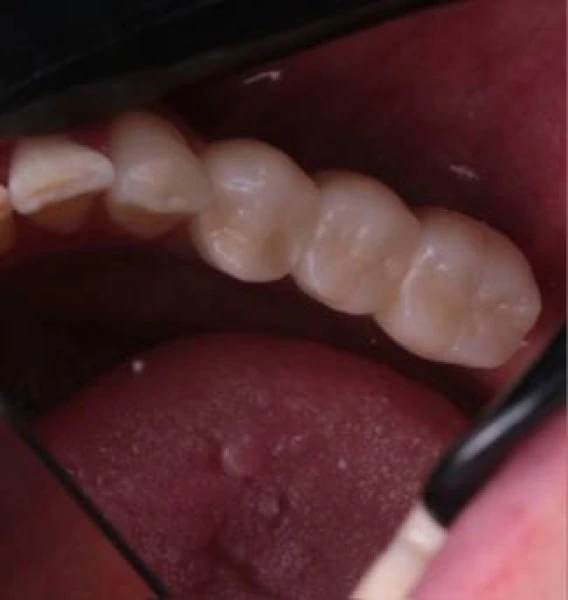 postoyannye-koronki-na-dva-implantata-sleva-and